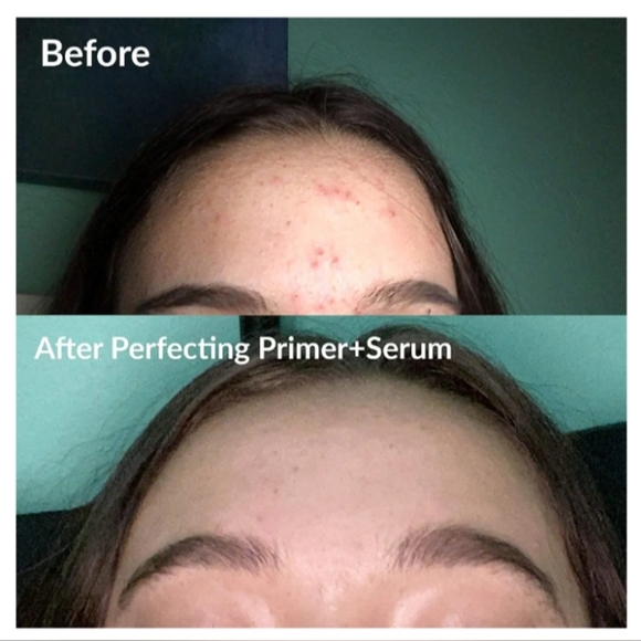 Frilliance Clear Skin Kit Perfecting Primer Serum & Facial Mist for Acne - Picture 4 of 16